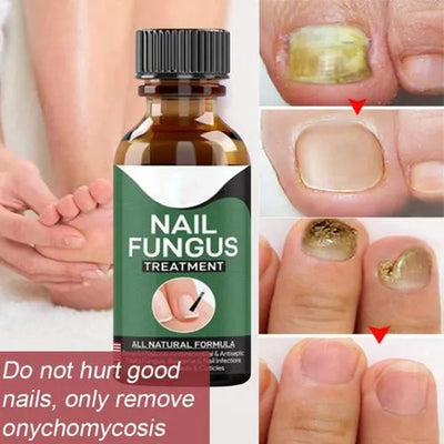 Nail Fungus Removal GelNail | Fungal Repair Serum